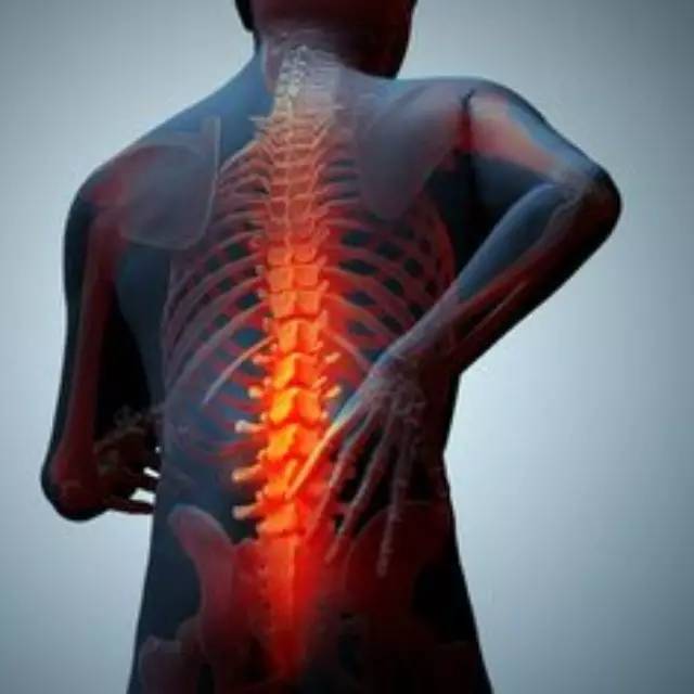 Ankylosing Spondylitis