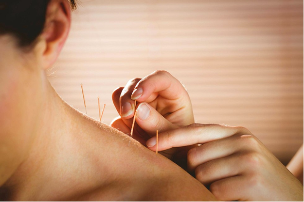 Acupuncture and Dry Needling