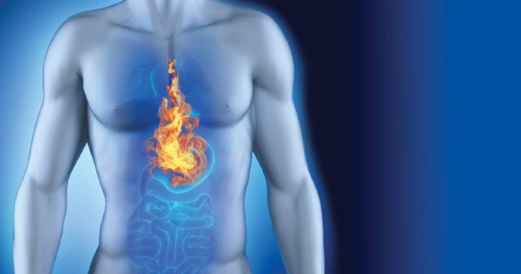 The Need for Formulating a Diet and Lifestyle Plan for Diminishing Acid Reflux