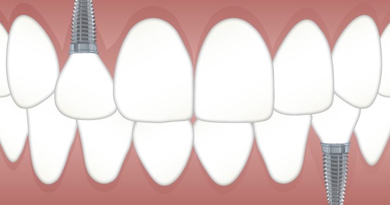 How to Find the Best Clinic for Dental Implants