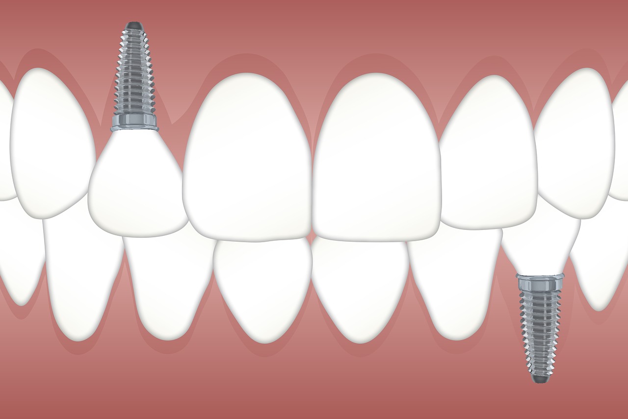 How to Find the Best Clinic for Dental Implants