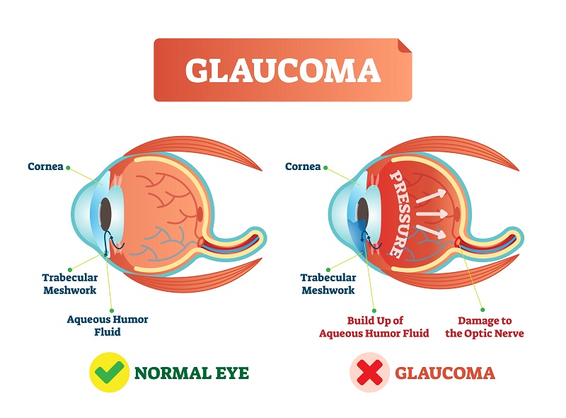 glaucoma treatment