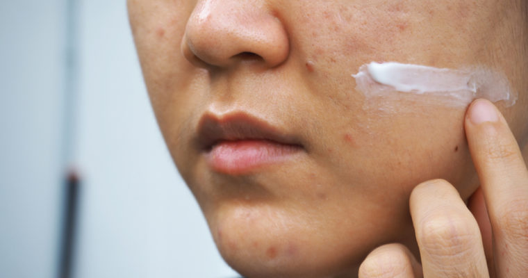 How to tell if you’re Skin is Purging? – A Complete Guide