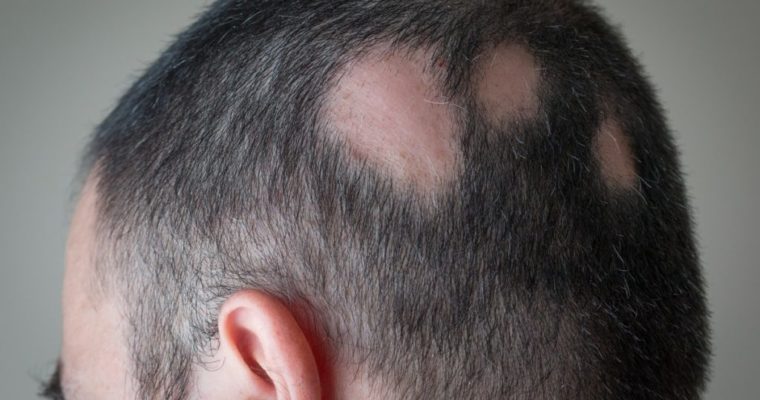 How Steroids Are Helpful in Alopecia Treatment?
