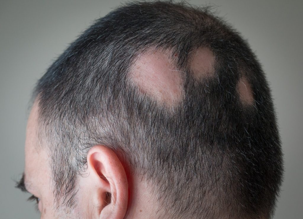 How Steroids Are Helpful in Alopecia Treatment?