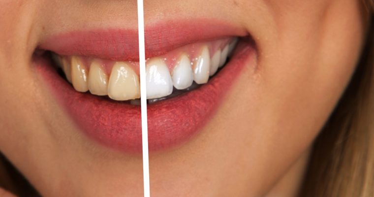 Foods and Drinks to Avoid After Getting Teeth Whitening Treatment