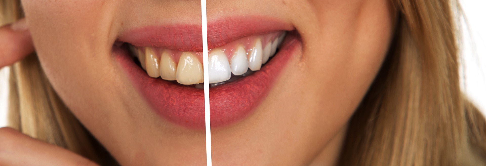 Foods and Drinks to Avoid After Getting Teeth Whitening Treatment