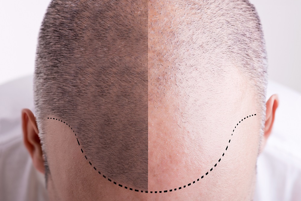 8 Myths about Hair Transplants That You Must Not Trust!