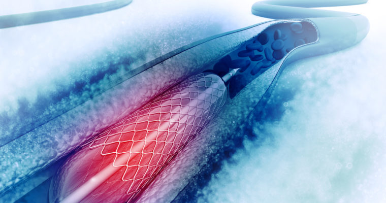 What Should You Avoid After an Angioplasty?