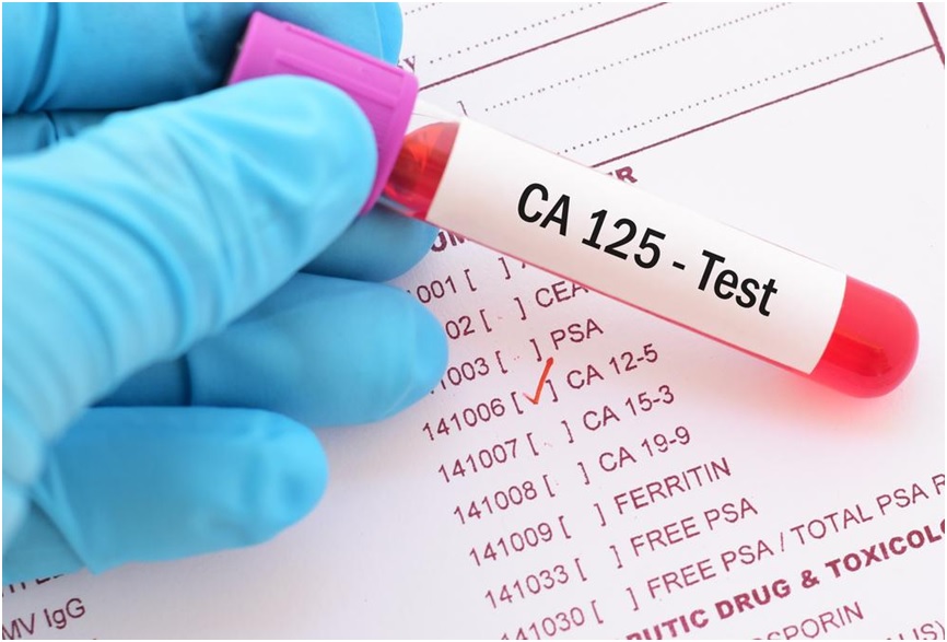 CA-125 Blood Test