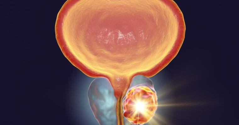 Things You Need to Know About Prostate Cancer: Its Symptoms and Treatment!