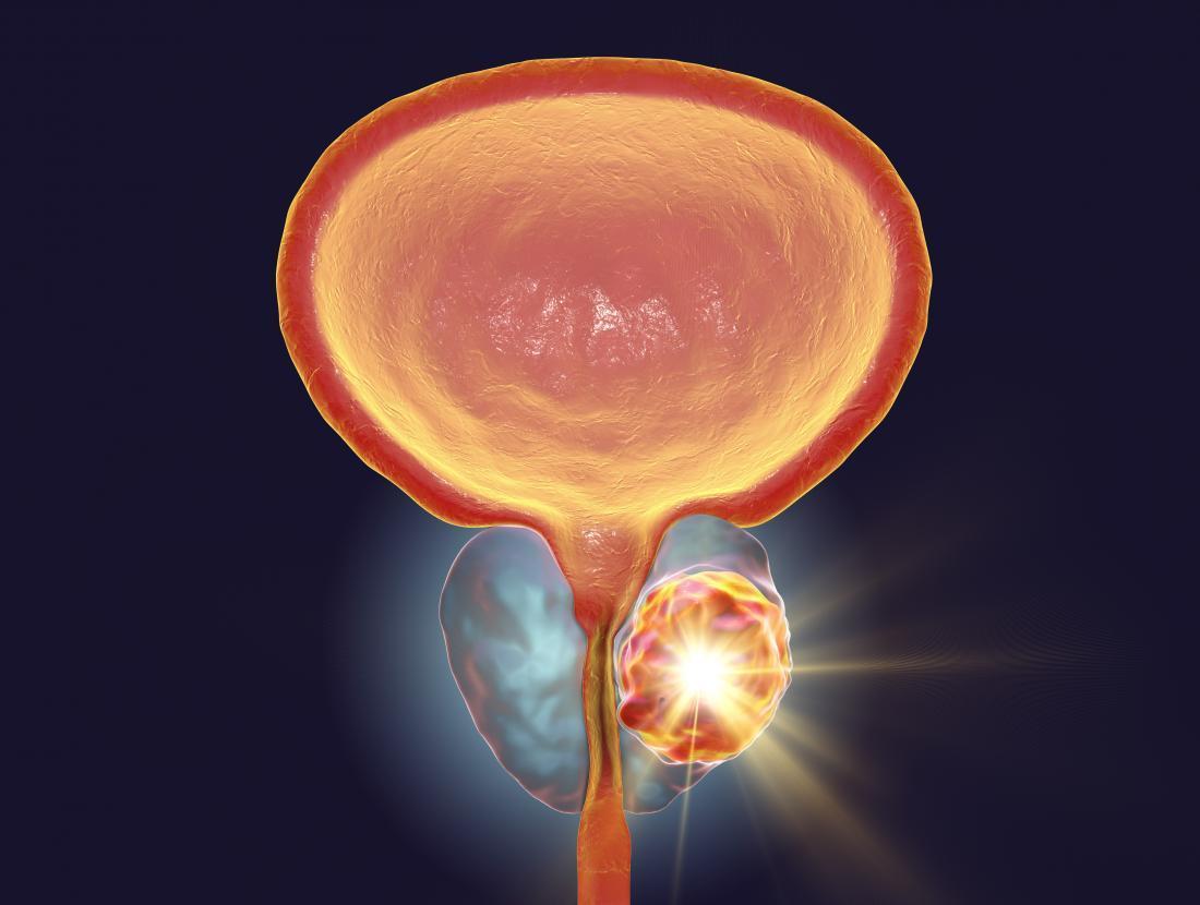Things You Need to Know About Prostate Cancer: Its Symptoms and Treatment!