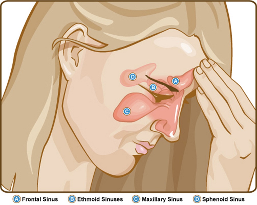 What Is Sinus, How To Treat?
