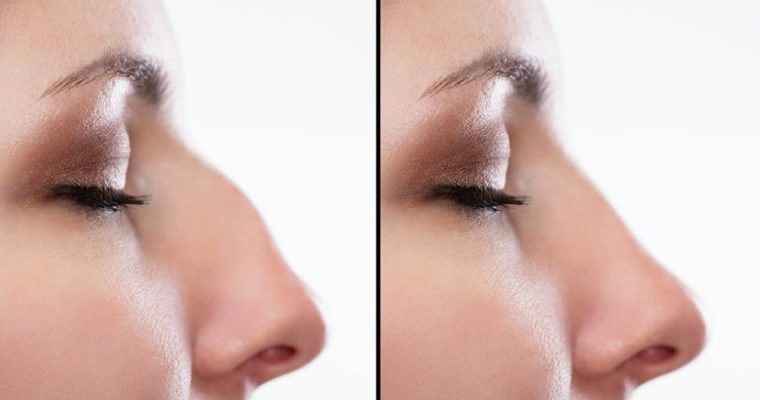 Can Rhinoplasty Improve your Quality of Life?