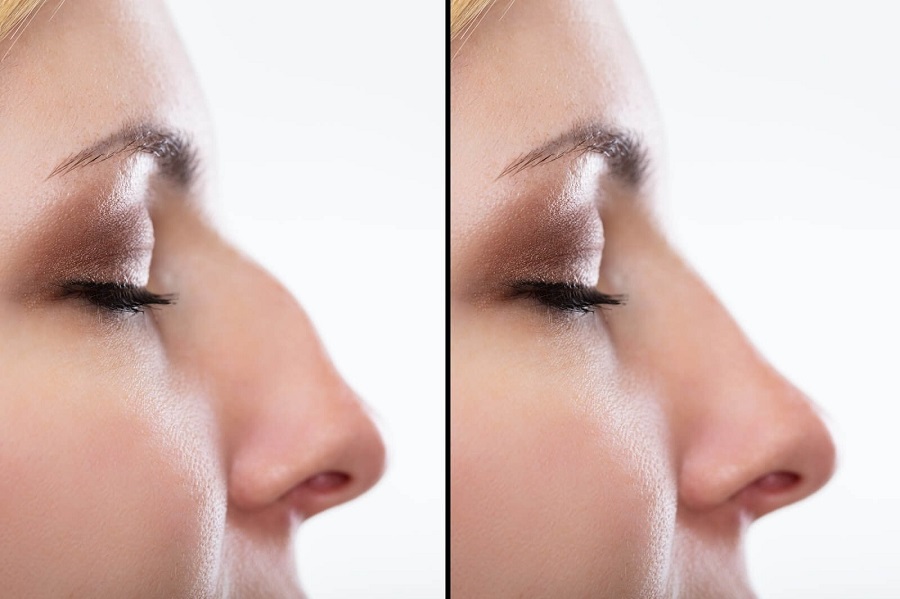 Can Rhinoplasty Improve your Quality of Life?