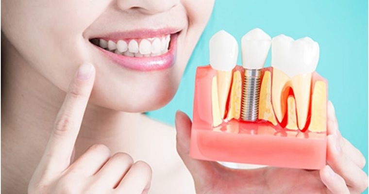 How Dental Implants Can Help Retain Your Beautiful Smile