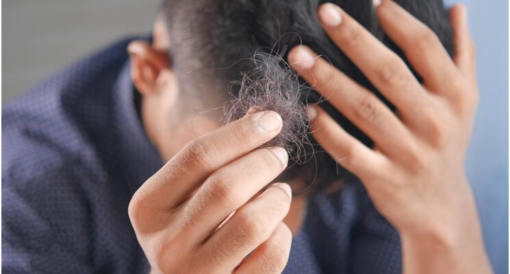 What are the Effects of Testosterone on Hair Loss?
