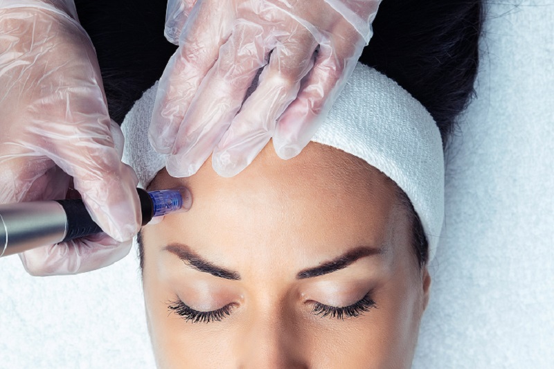 Everything You Need to Know About Skin Needling