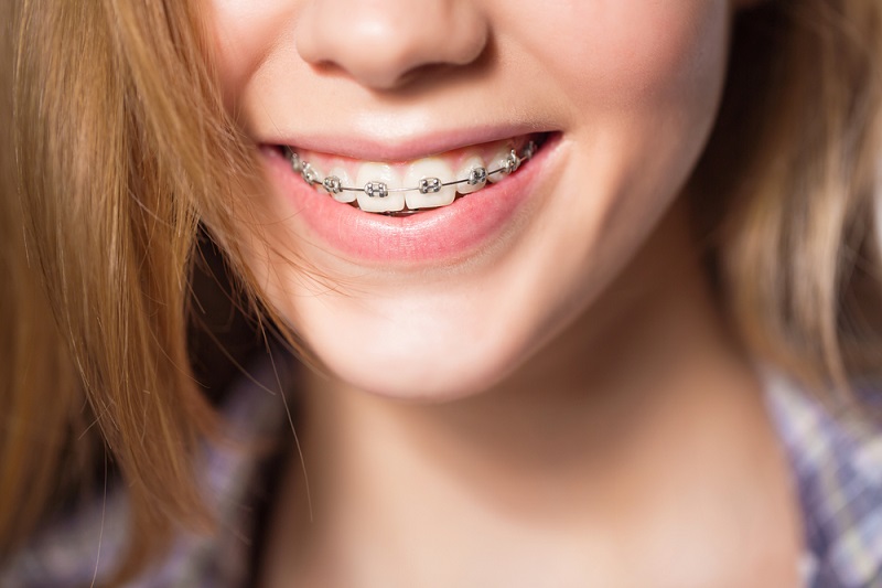 4 Top Questions You Might Have About Orthodontists