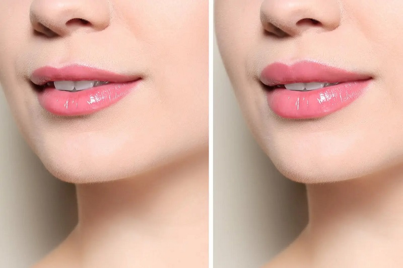 5 Things To Consider Before Getting Lip Injections In Vancouver