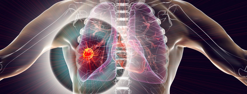 Complete Guide on Theranostics Treatment