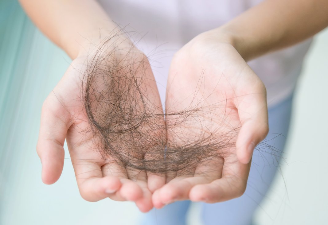 thinning hair is stress