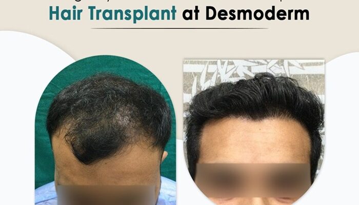 9 Signs a Hair Transplant Clinic May Not Be Right for You